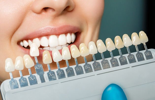 Dental Veneers
