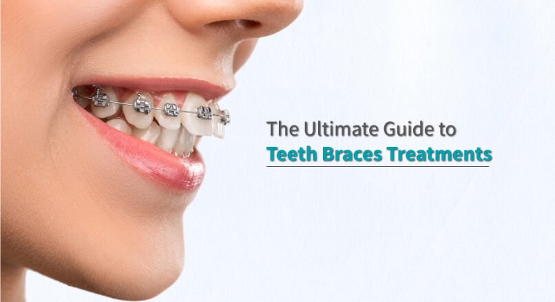 guide to Teeth braces treatments
