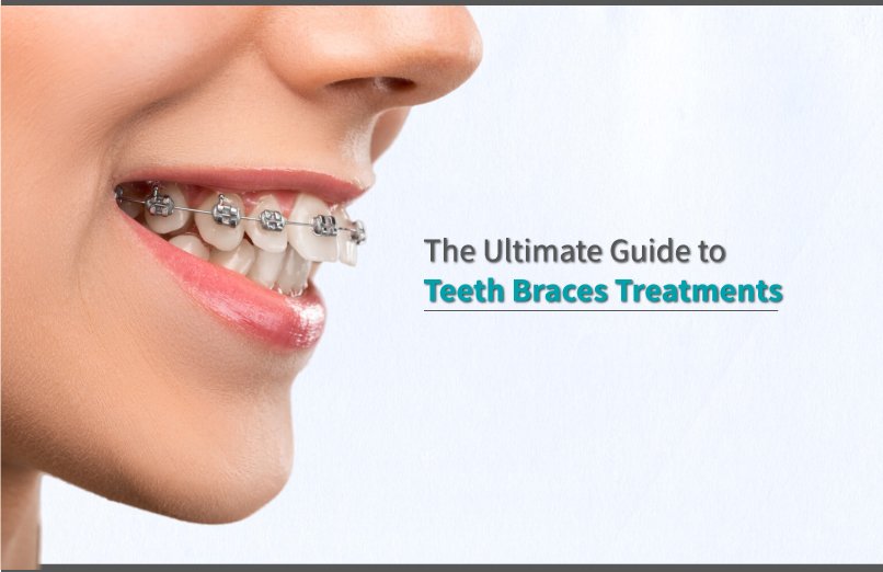 The Ultimate Guide to Teeth Braces Treatments