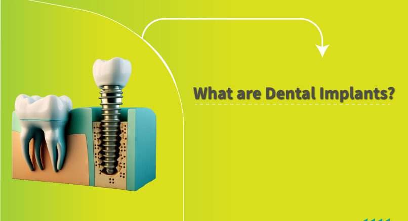 What is Dental Implants