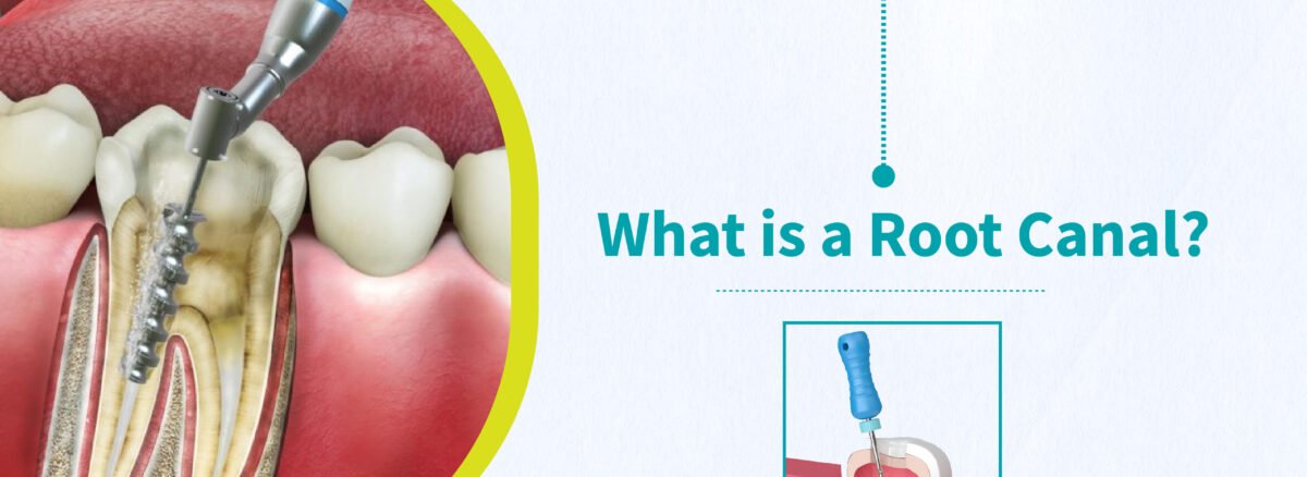 Root Canal Treatment Specialist