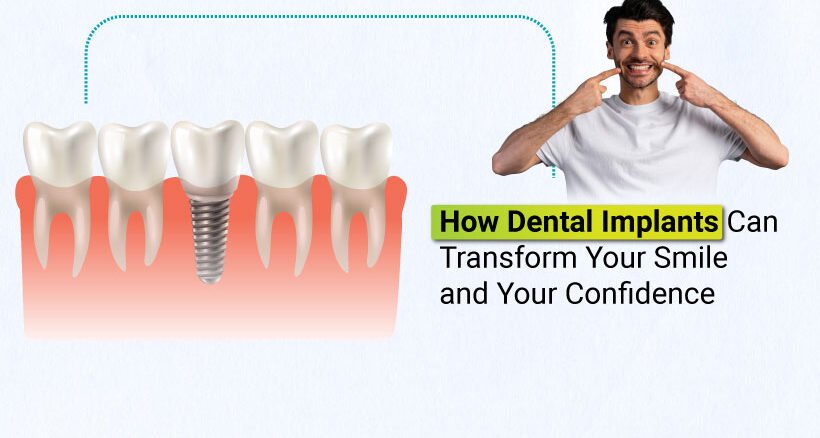 Dental Implants Treatment Ahmedabad