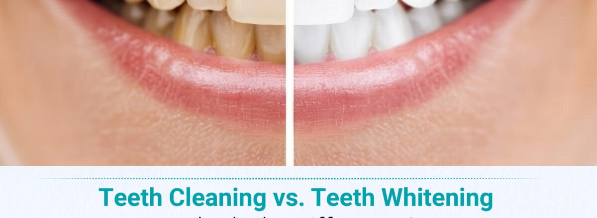 Difference between teeth cleaning & teeth whitening