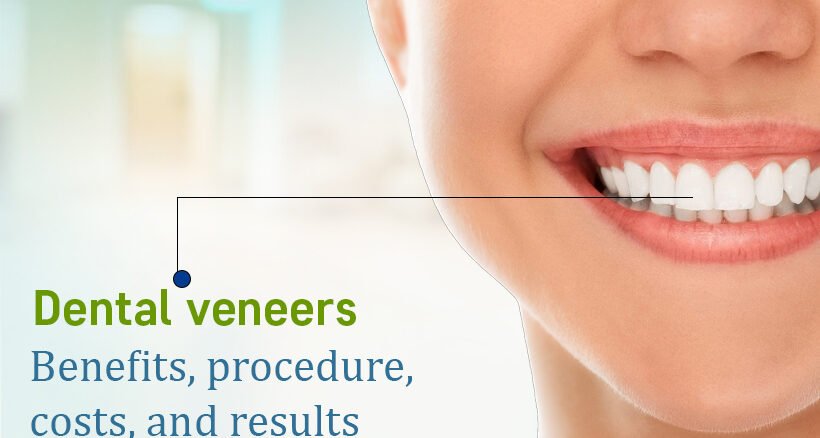 Dental Veneers Treatment in Ahmedabad
