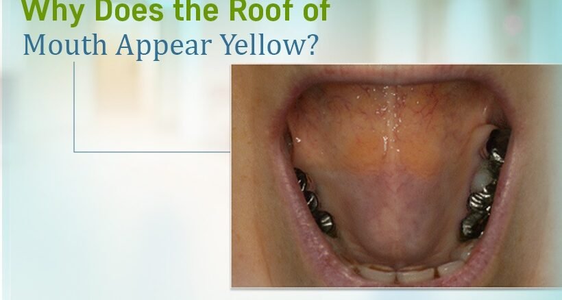 Roof of the Mouth Yellow
