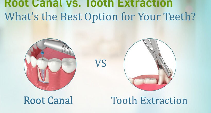 Root Canal vs Tooth Extraction