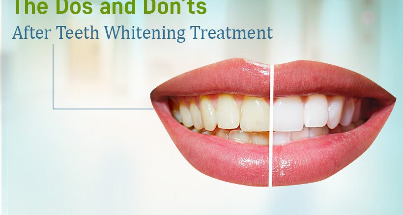 Teeth whitening Treatment in Ahmedabad