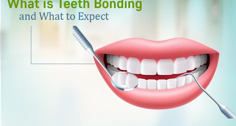Teeth Bonding Treatment in Ahmedabad