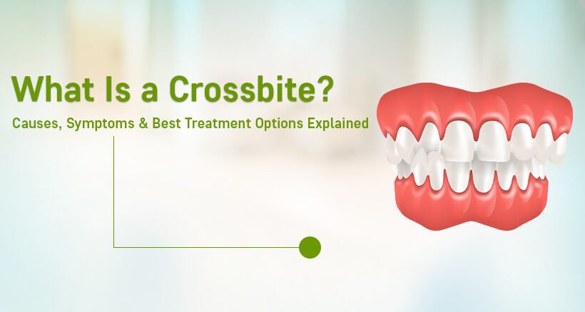 Dental Crossbite Treatment in Ahmedabad