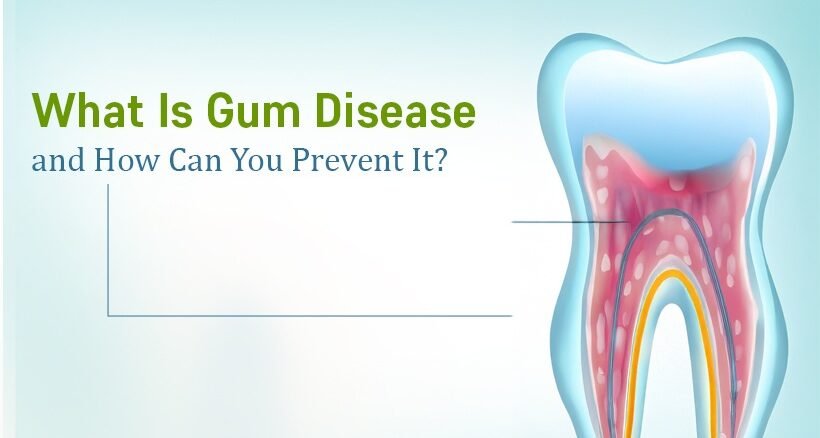 Gum disease treatment in Ahmedabad