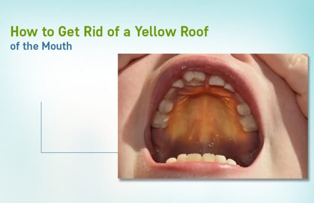 how to get rid of the yellow roof of mouth