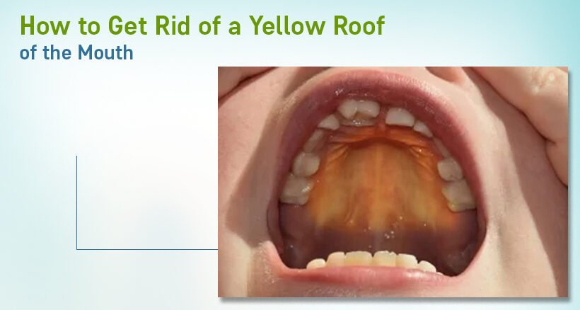 how to get rid of the yellow roof of mouth