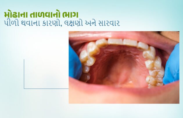 Symptoms and Treatment of Yellowing of the Palate