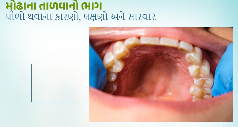 Symptoms and Treatment of Yellowing of the Palate