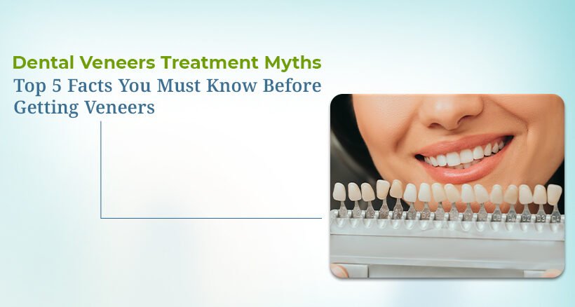 Dental Veneers Treatment Myths and Facts
