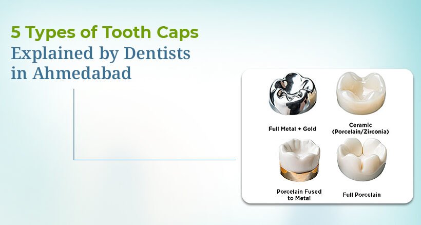 Types of Tooth Caps