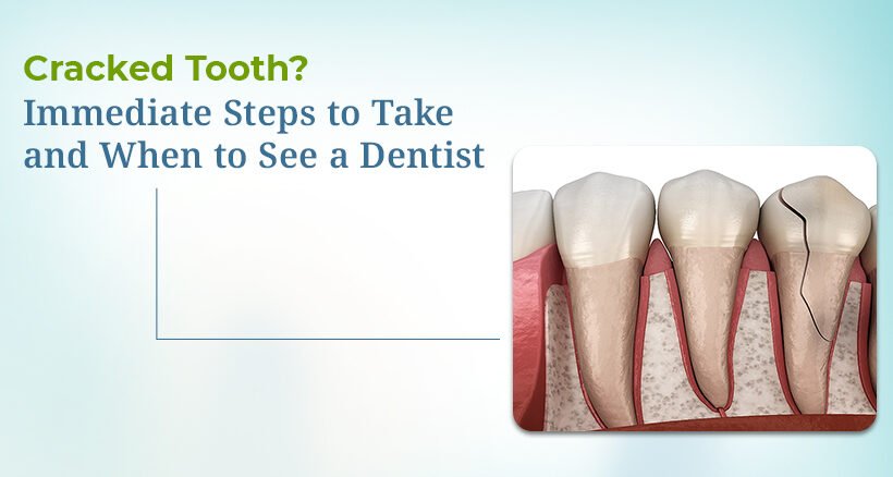 Cracked Tooth