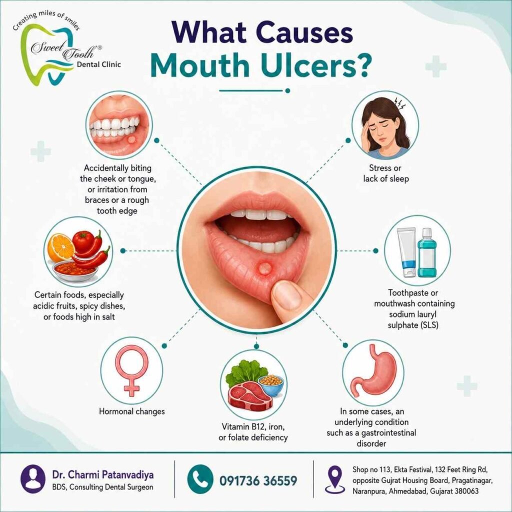 What Causes Mouth Ulcers