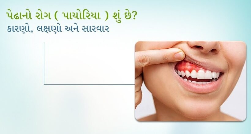 પેઢાનો રોગ (પાયોરિયા) શું છે