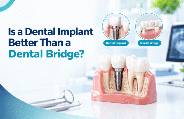 Dental Implant vs. Dental Bridge