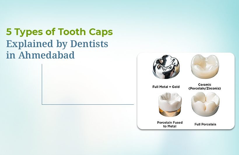 Types of Tooth Caps