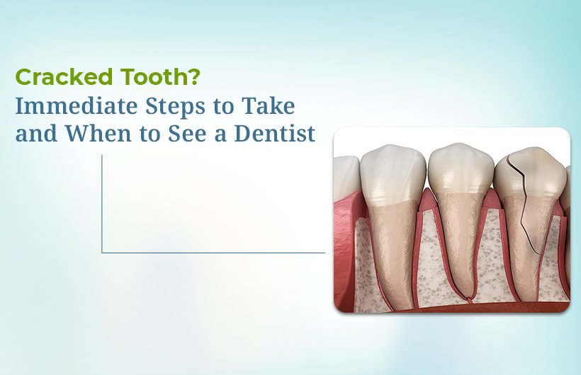 Cracked Tooth