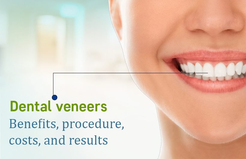 Dental Veneers Treatment in Ahmedabad