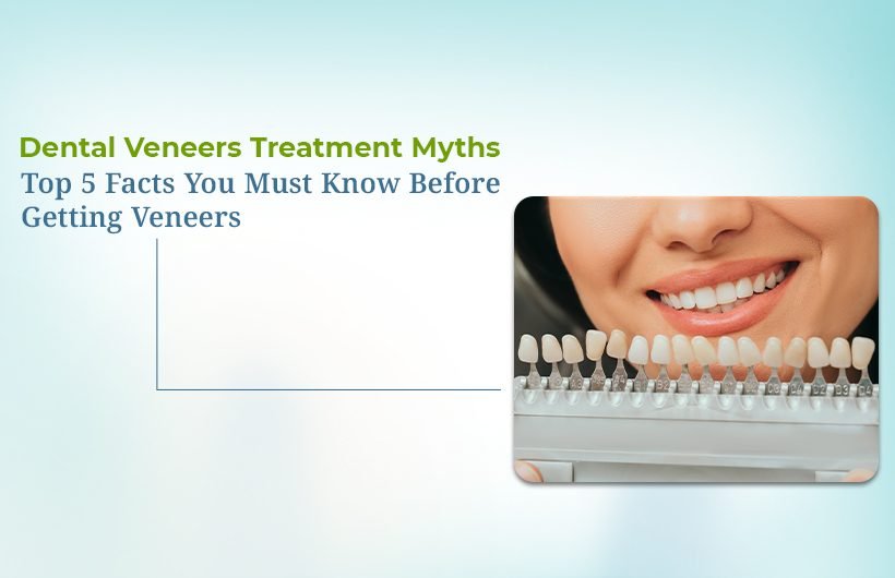 Dental Veneers Treatment Myths and Facts