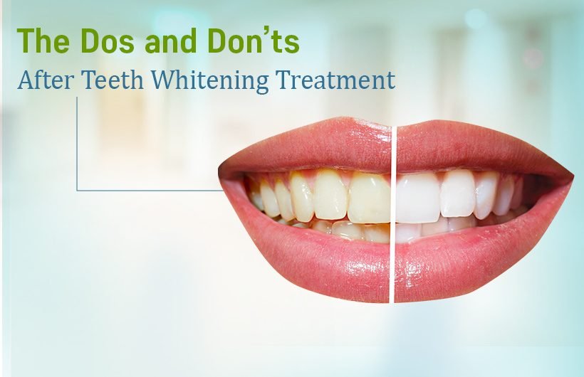 Teeth whitening Treatment in Ahmedabad