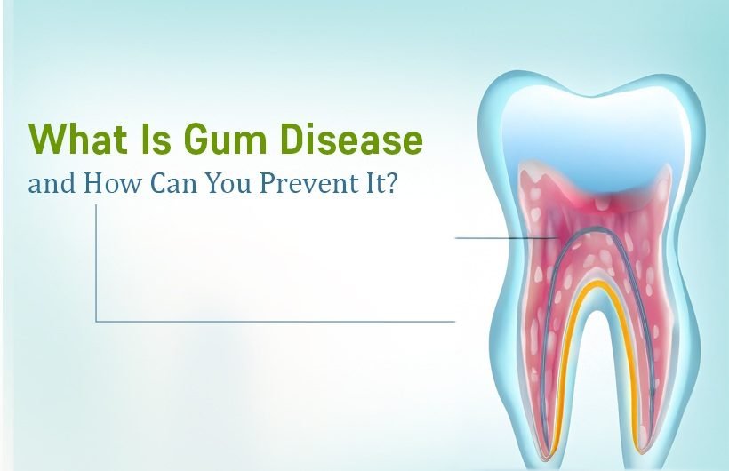 Gum disease treatment in Ahmedabad