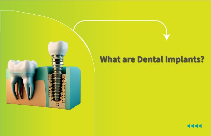 What is Dental Implants