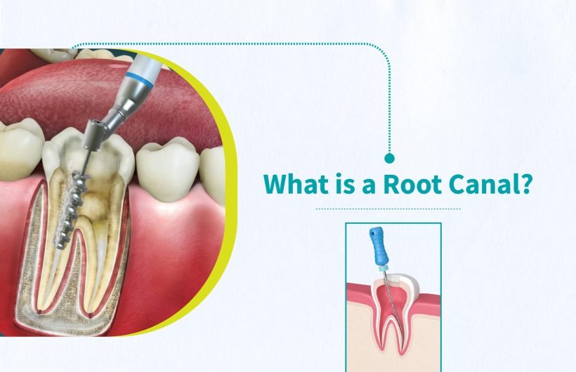 Root Canal Treatment Specialist