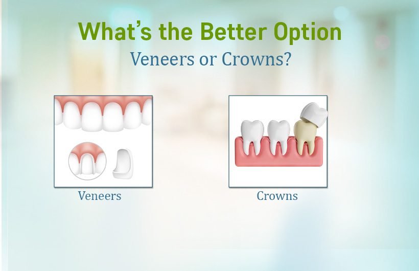 Remove term: Dental Crowns and Veneer Treatment Dental Crowns and Veneer Treatment